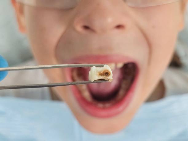 Best Emergency Wisdom Teeth Removal in Edgerton, OH